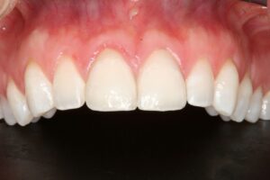 After 2 single All ceramic crowns procedure