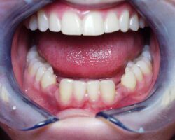 dental implants philadelphia before photo