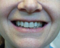 porcelain veneers Philadelphia pa before photo