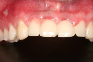 closeup After fixing tooth Implant Trauma
