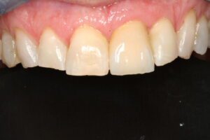 Single tooth implant case