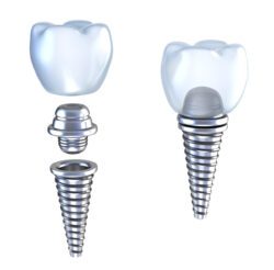 dental implant in Bala Cynwyd, PA