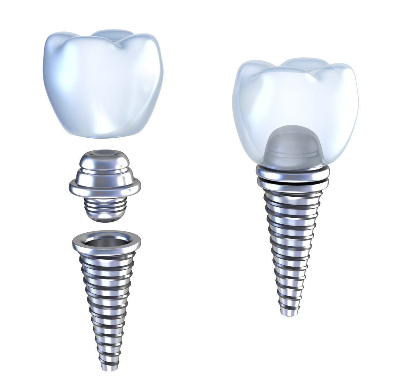 Single Tooth Dental Implants Philadelphia PA