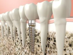 single dental implant in philadelphia, pa