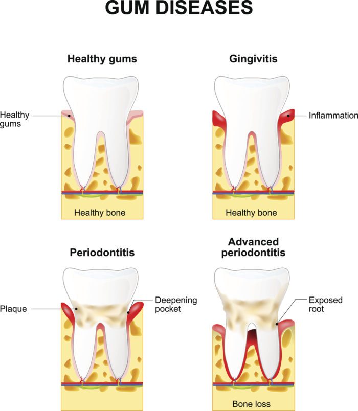 Gum disease progression chart in Bala Cynwyd, PA