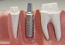 Bala Cynwyd, PA Dental Implants