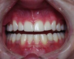 dental implants after photo philadelphia pa