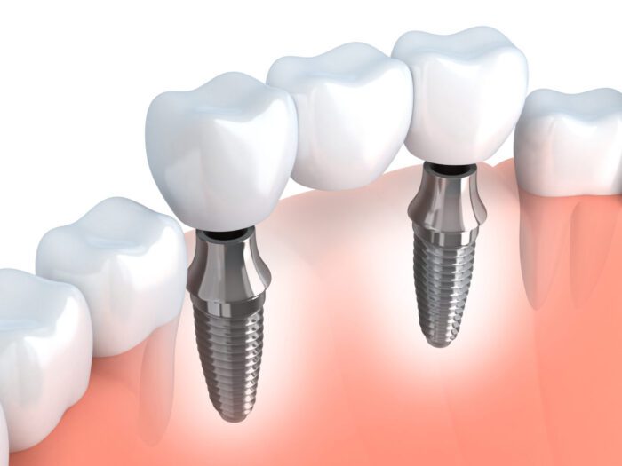 Dental implant Model Philadelphia PA Implant dentist