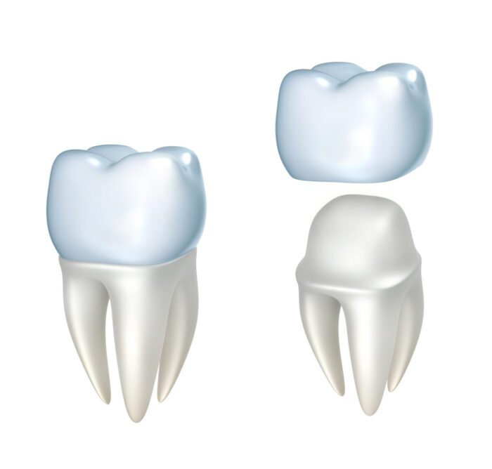 dental crown restoration in bala cynwyd pa