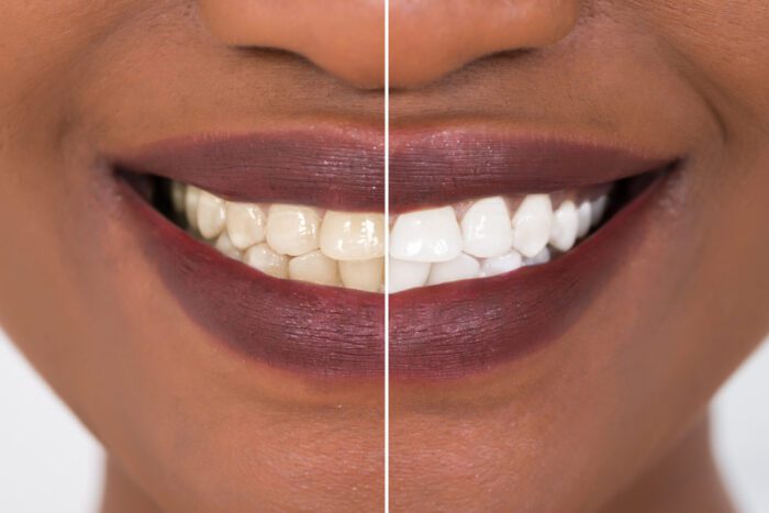 teeth whitening treatment for discolored teeth in bala cynwyd pa
