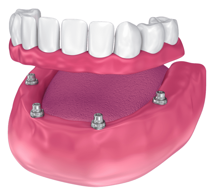 all on four dental implants in bala cynwyd pa