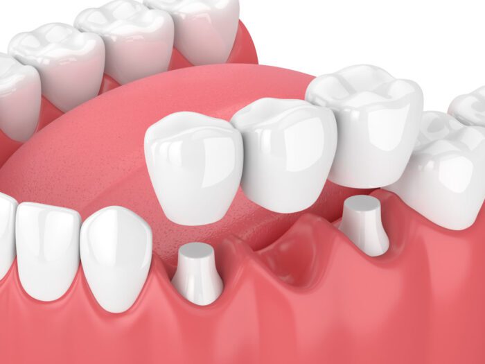 dental bridge for missing teeth bala cynwyd pa