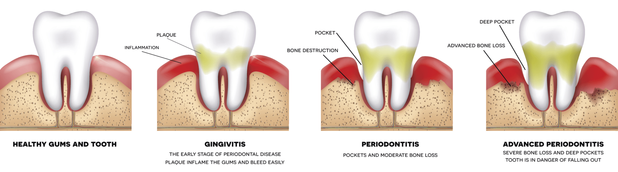 Periodontal therapy and gum disease treatment in Bala Cynwyd Pennsylvania