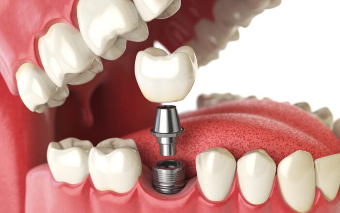 dental implant for missing teeth in Bala Cynwyd, Pennsylvania