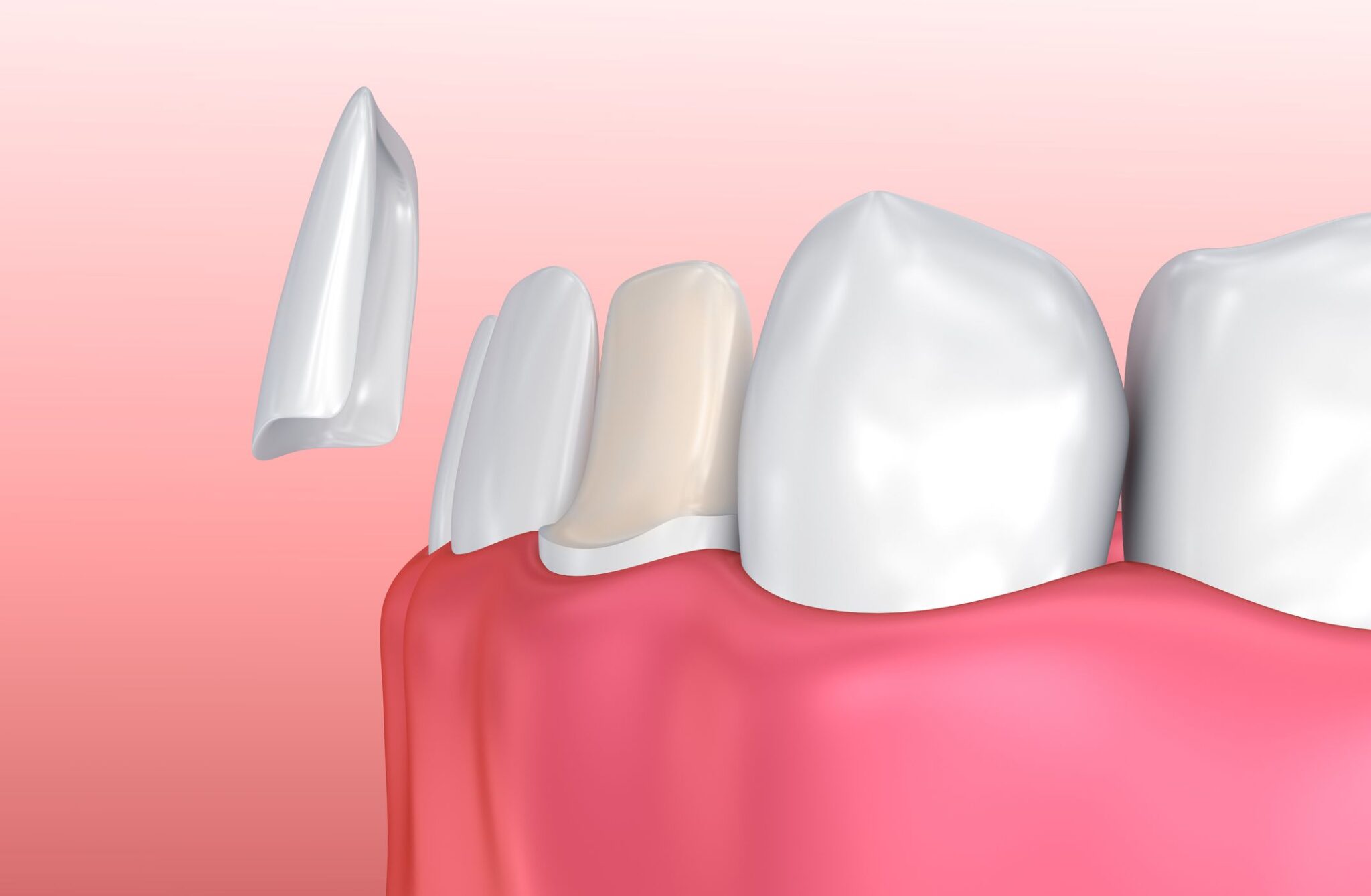 Porcelain Veneers vs Dental Crowns Philadelphia, PA Dentist