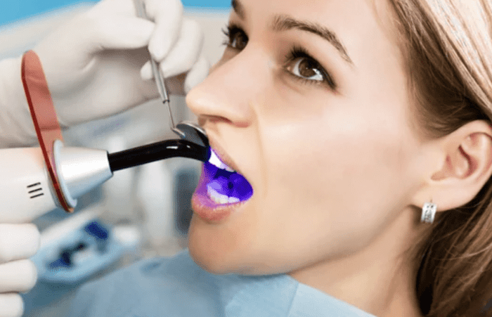 Woman getting a dental bonding treatment for cosmetic issues dentist in Philadelphia Pennsylvania