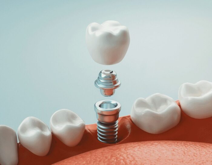 3D image of dental implant individual parts restorative dentistry dentist in Philadelphia Pennsylvania
