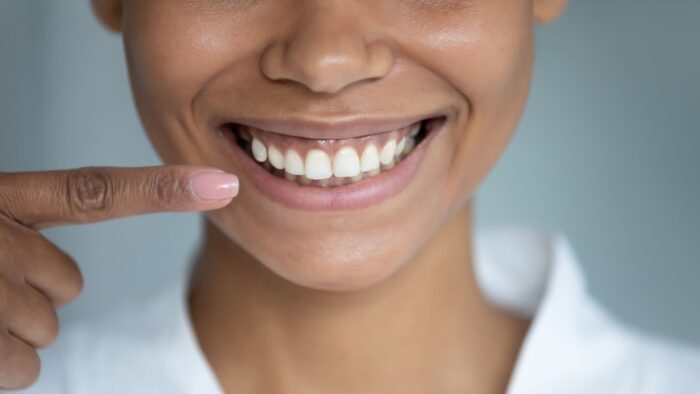 Woman pointing finger at perfect straight white toothy smile restorative dentistry dentures dental bridges dentist in Philadelphia Pennsylvania