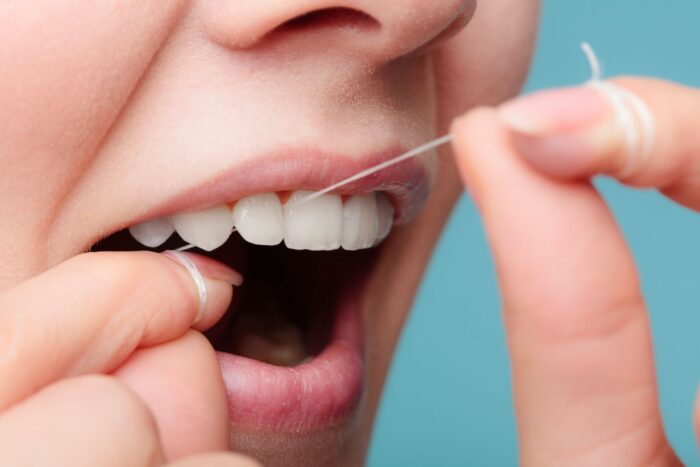 Can You Floss with Veneers?