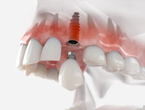 Dental implant restoration provides patients an opportunity to regain their smiles and enhance their oral health.