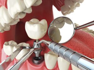 Missing teeth can affect your confidence and oral health. Fortunately, modern dentistry offers several replacement options.