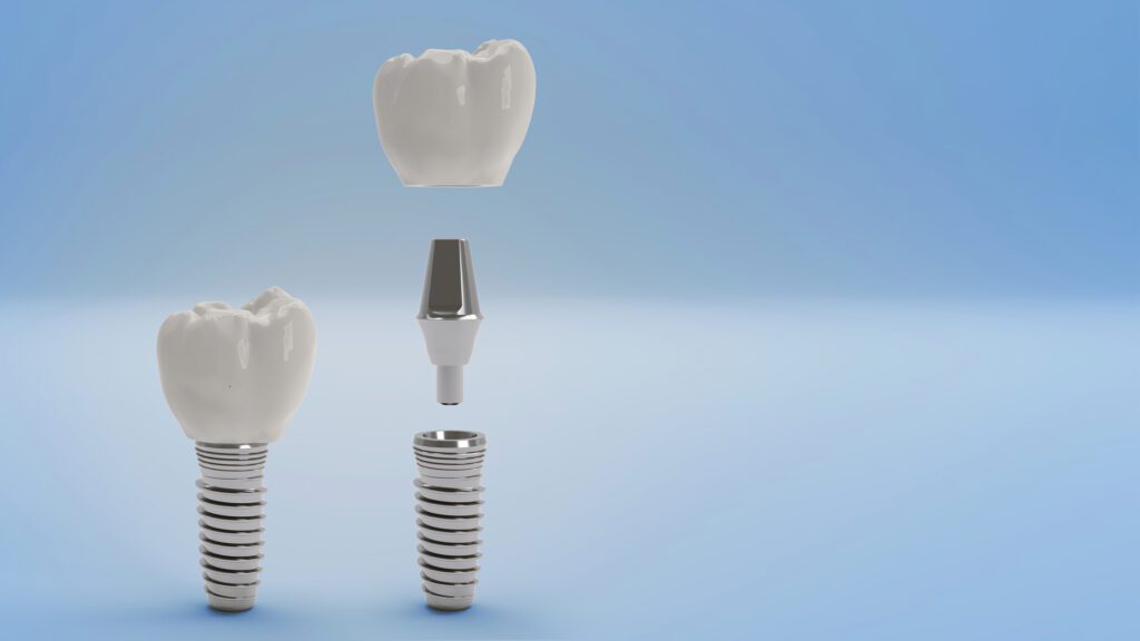 Dental Implants in Philadelphia PA