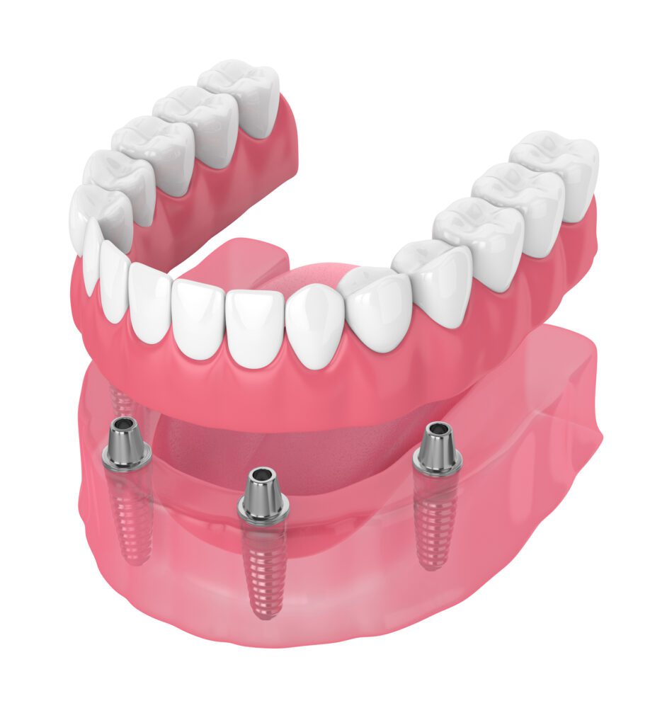 The All on Four dental implants method offers a less invasive option. Patients could receive a complete set of teeth with fewer implants.