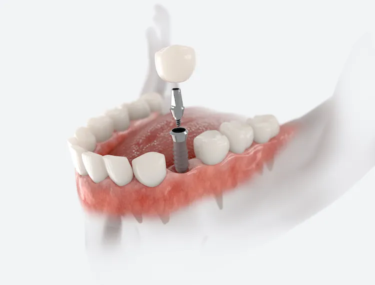 Dental Implant Risks and Success Rates: What Every Patient Deserves to Know
