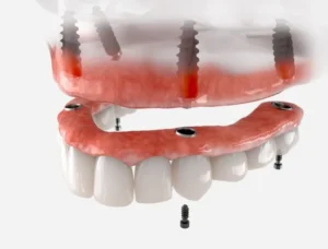 Top 5 Questions About Dental Implants in Philadelphia, PA